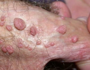 Genital siğil görünümü